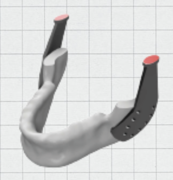 initial mandible implant cad design with plate and screw locations